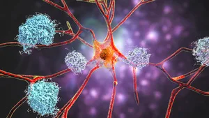 Neurons in Alzheimer's disease. 3D illustration showing amyloid plaques in brain tissue, neurofibrillary tangles and distruction of neuronal networks